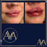 Cleft lip revision